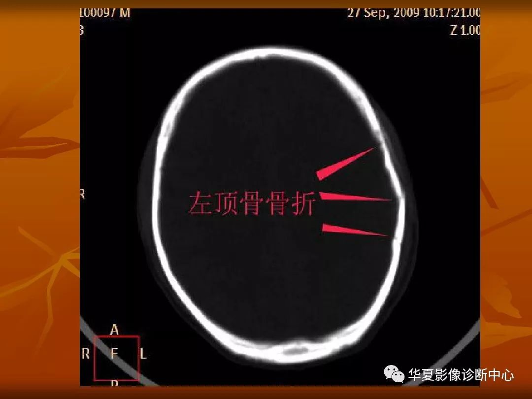 影像PPT - 【PPT】颅骨外伤性骨折CT诊断-29