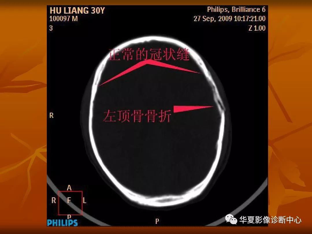 影像PPT - 【PPT】颅骨外伤性骨折CT诊断-28