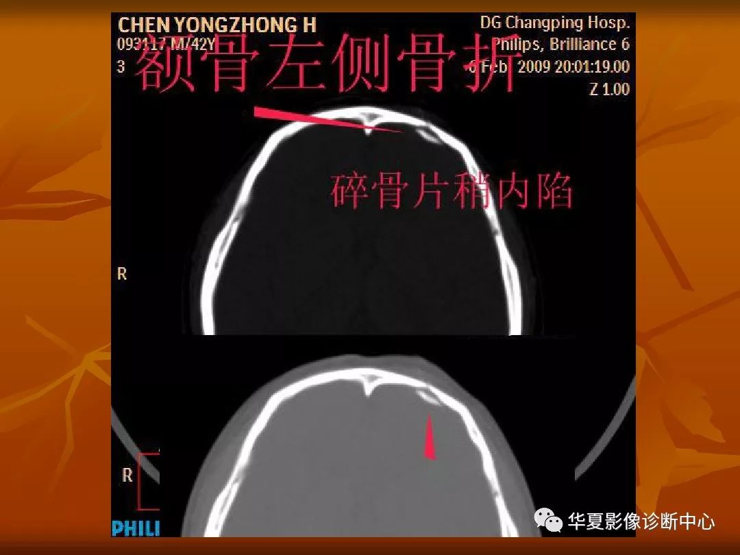 影像PPT - 【PPT】颅骨外伤性骨折CT诊断-42