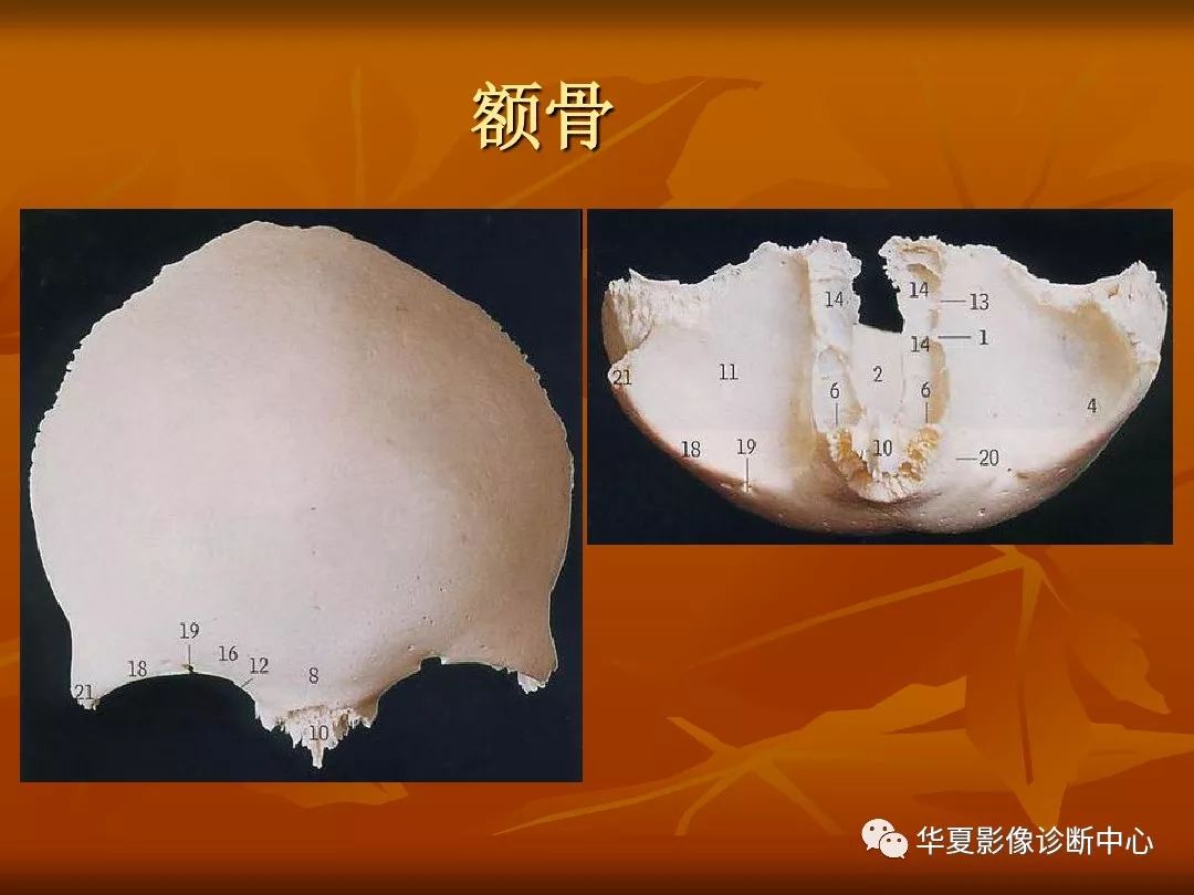 影像PPT - 【PPT】颅骨外伤性骨折CT诊断-41