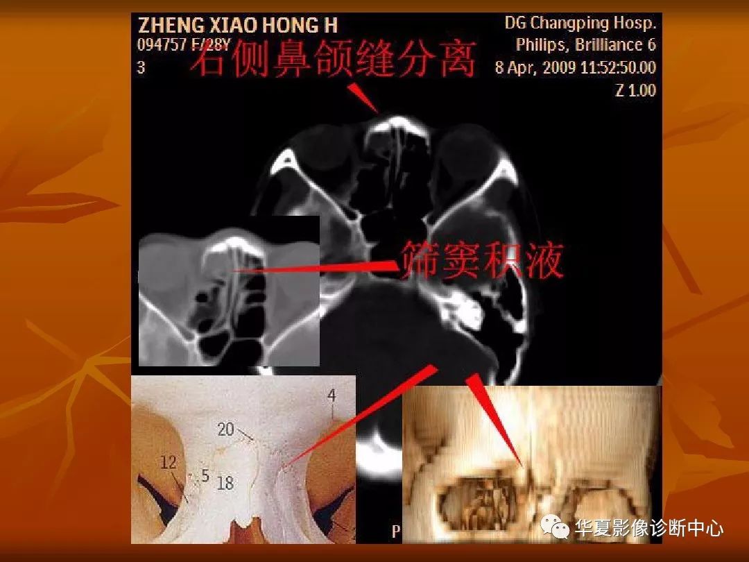 影像PPT - 【PPT】颅骨外伤性骨折CT诊断-44