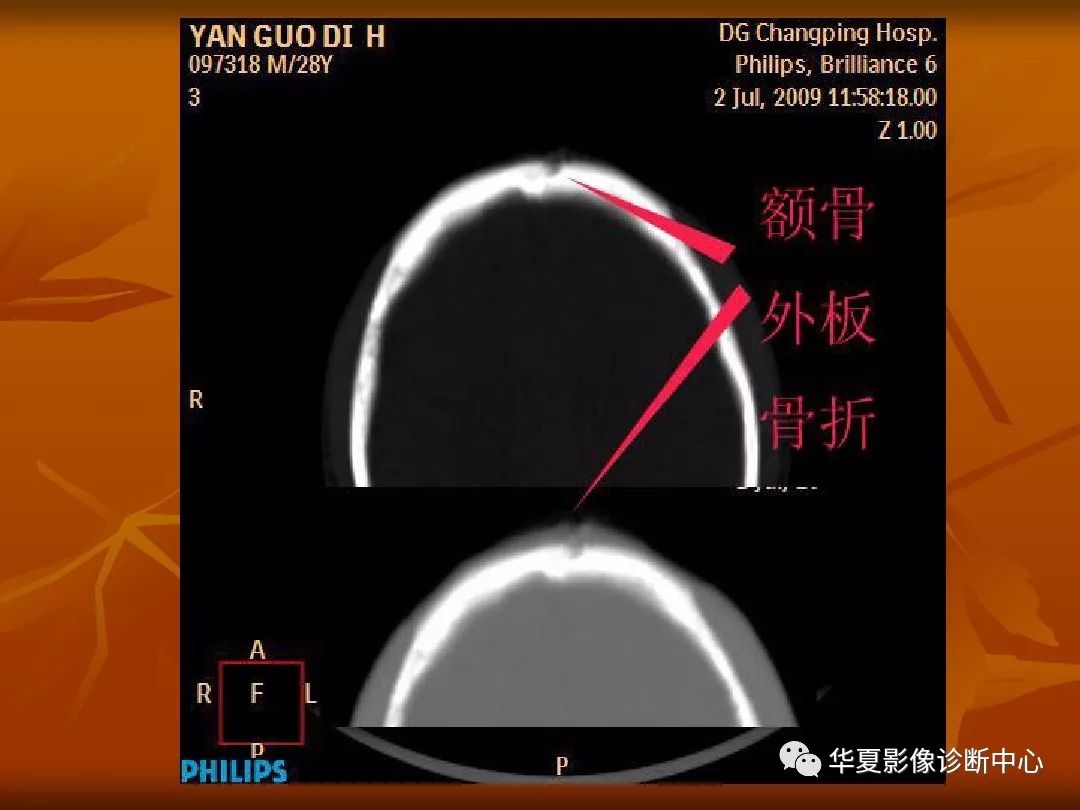 影像PPT - 【PPT】颅骨外伤性骨折CT诊断-49