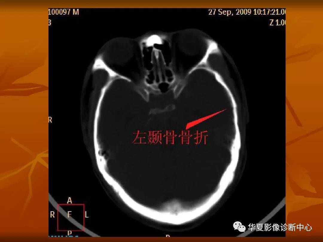 影像PPT - 【PPT】颅骨外伤性骨折CT诊断-54