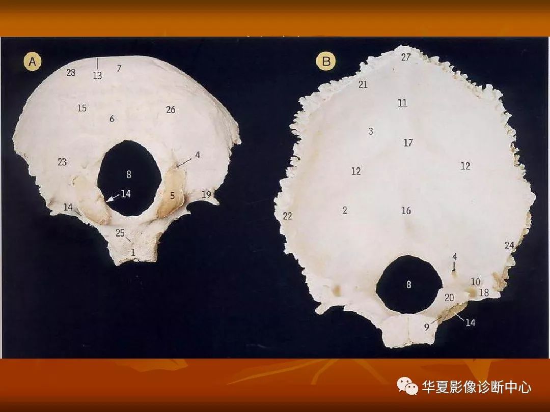 影像PPT - 【PPT】颅骨外伤性骨折CT诊断-57