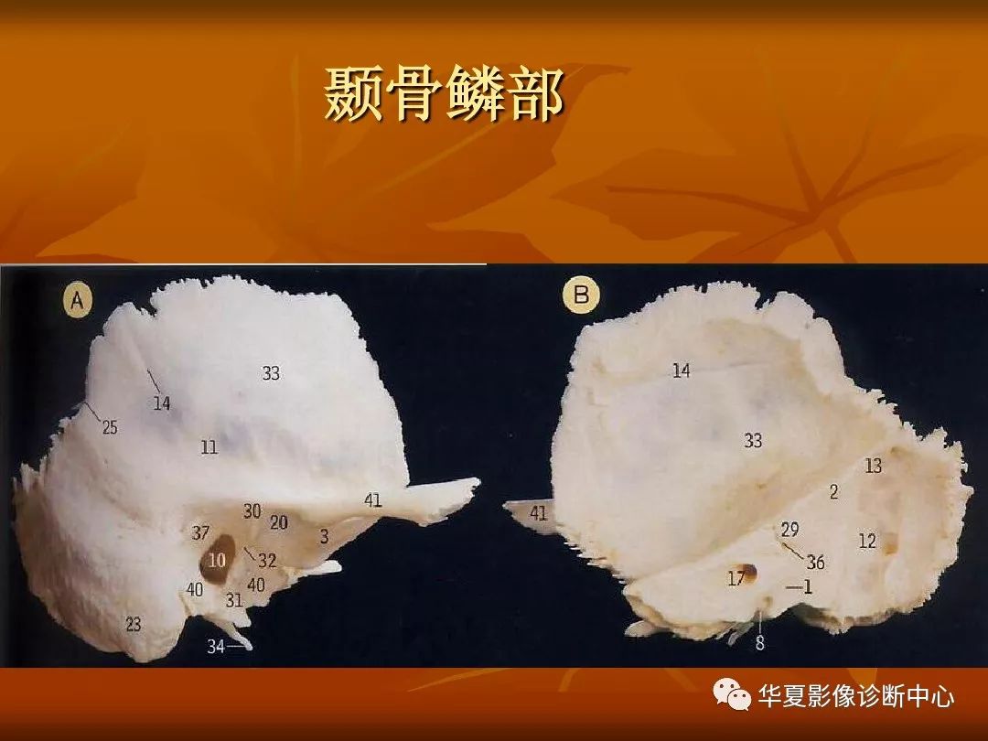 影像PPT - 【PPT】颅骨外伤性骨折CT诊断-53