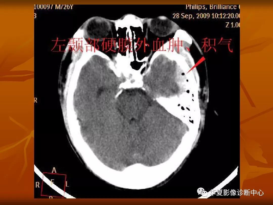 影像PPT - 【PPT】颅骨外伤性骨折CT诊断-55