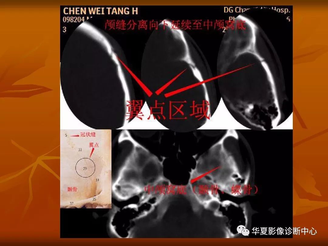 影像PPT - 【PPT】颅骨外伤性骨折CT诊断-66