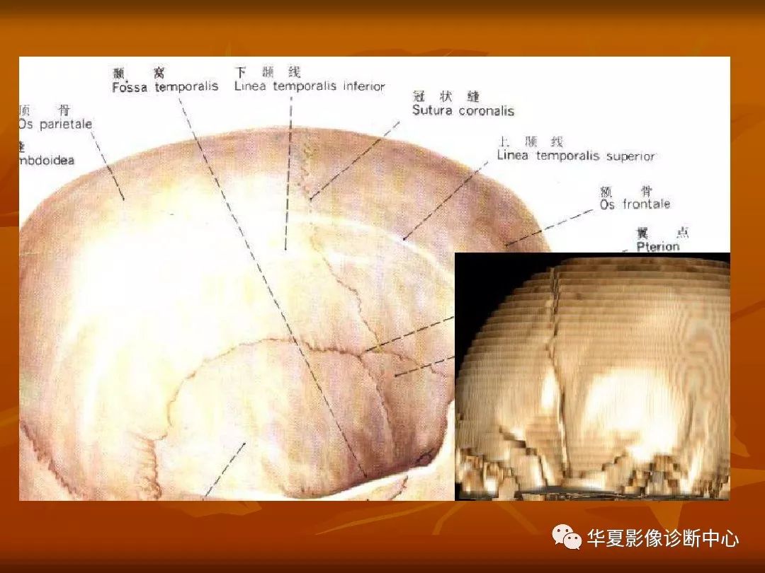 影像PPT - 【PPT】颅骨外伤性骨折CT诊断-68