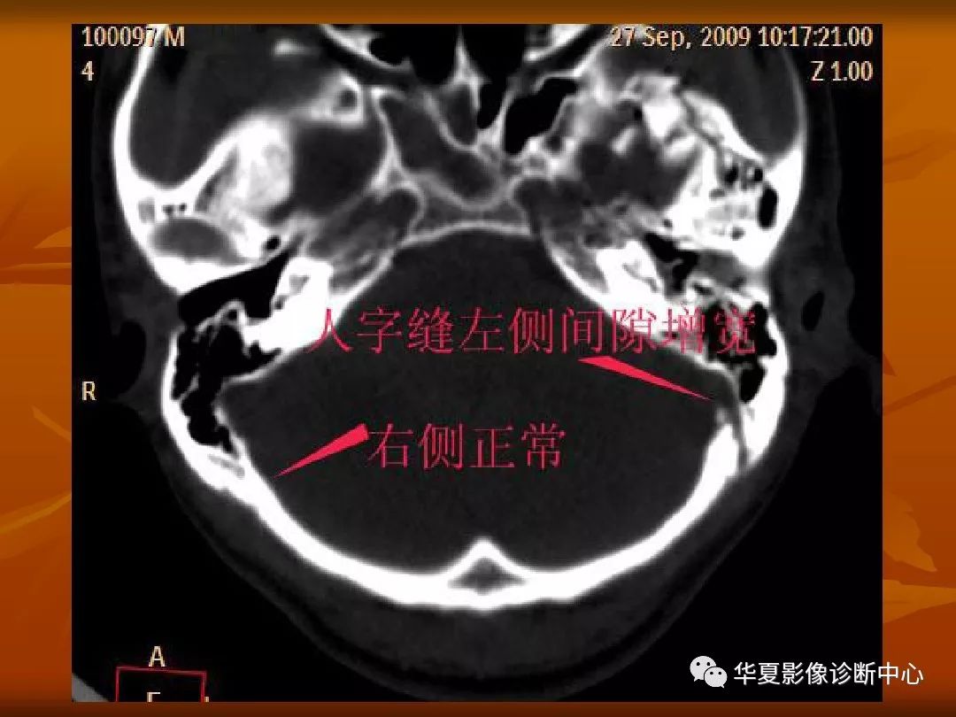 影像PPT - 【PPT】颅骨外伤性骨折CT诊断-71