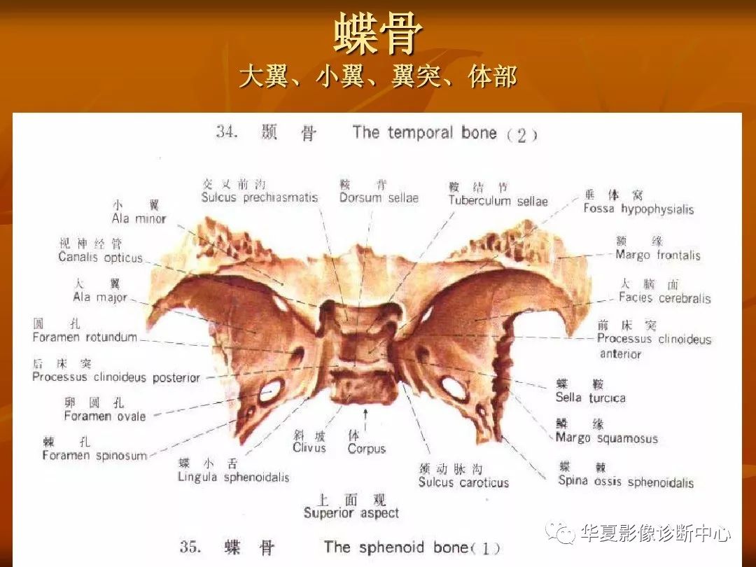 影像PPT - 【PPT】颅骨外伤性骨折CT诊断-78