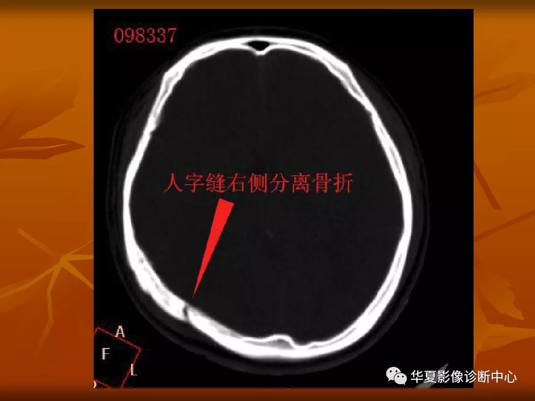 影像PPT - 【PPT】颅骨外伤性骨折CT诊断-70