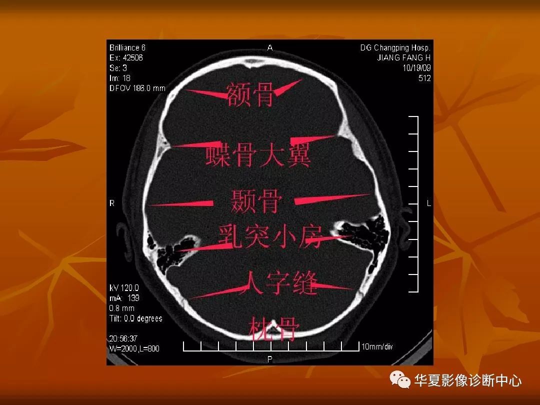 影像PPT - 【PPT】颅骨外伤性骨折CT诊断-83