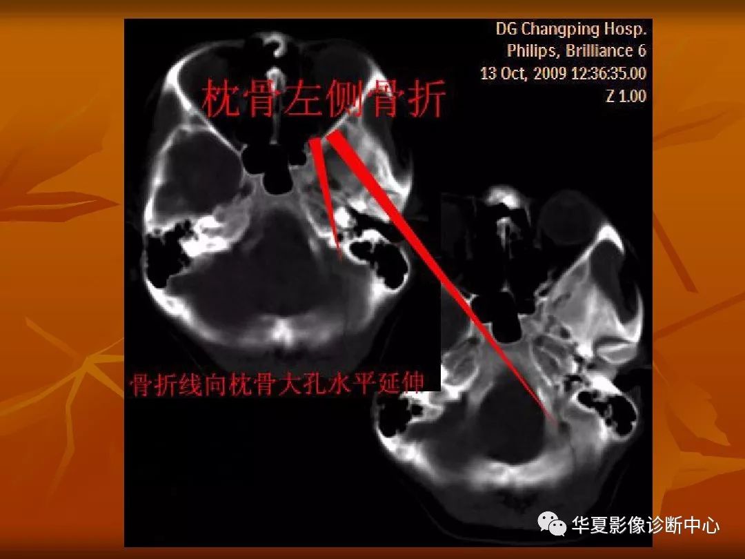 影像PPT - 【PPT】颅骨外伤性骨折CT诊断-60
