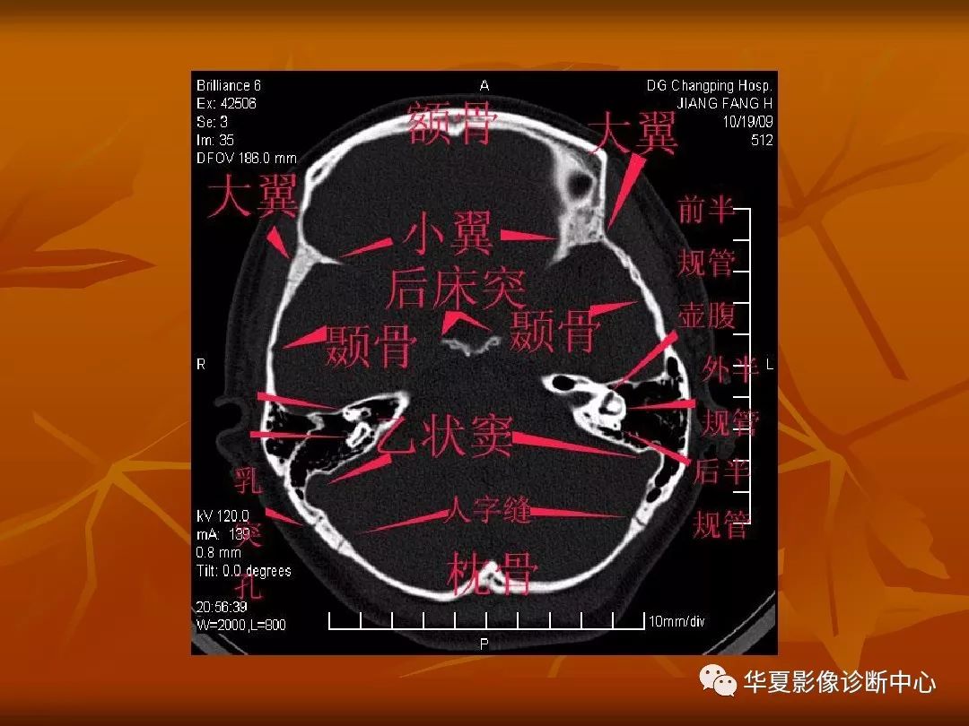 影像PPT - 【PPT】颅骨外伤性骨折CT诊断-86