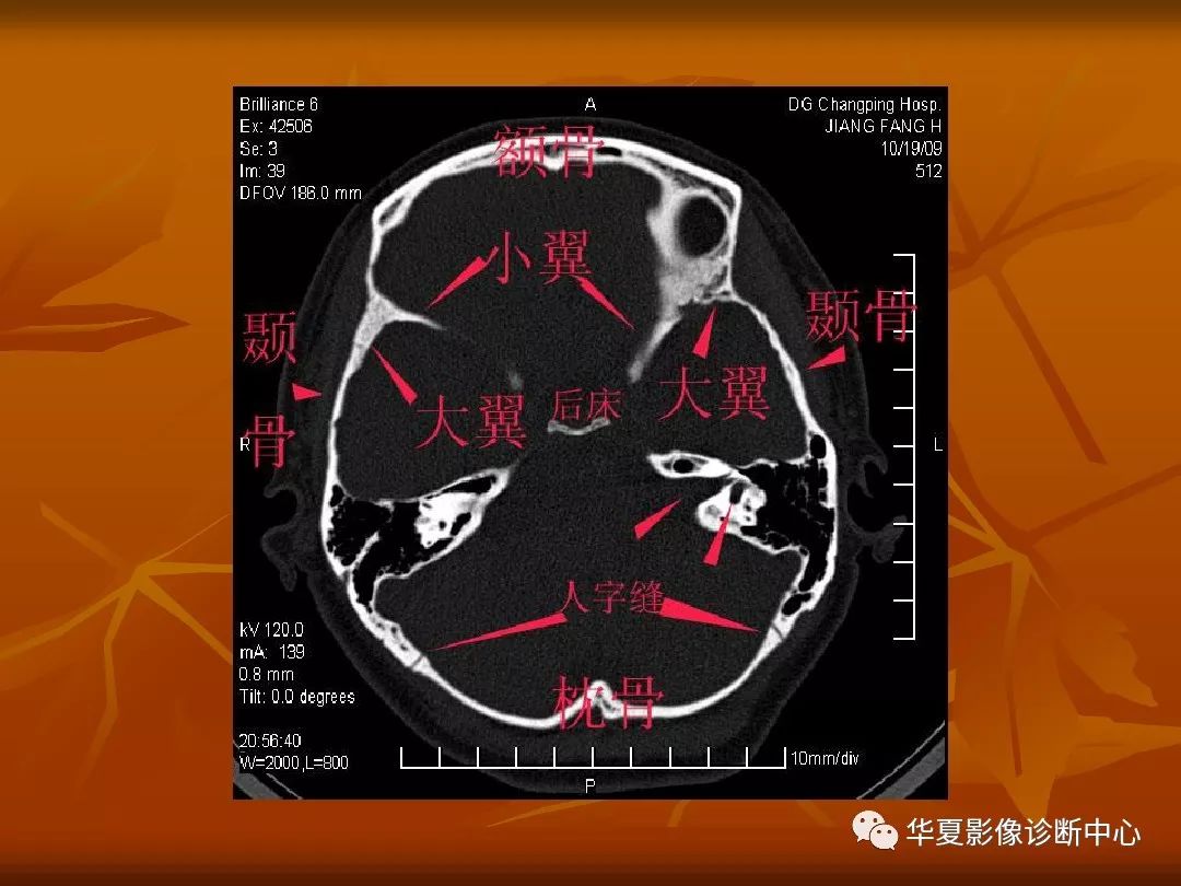 影像PPT - 【PPT】颅骨外伤性骨折CT诊断-87