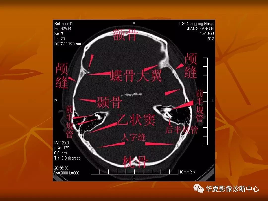 影像PPT - 【PPT】颅骨外伤性骨折CT诊断-85