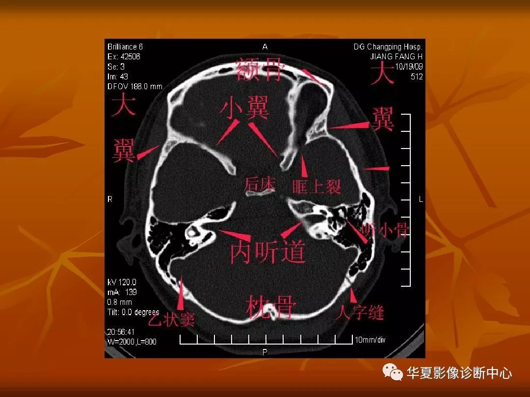 影像PPT - 【PPT】颅骨外伤性骨折CT诊断-88