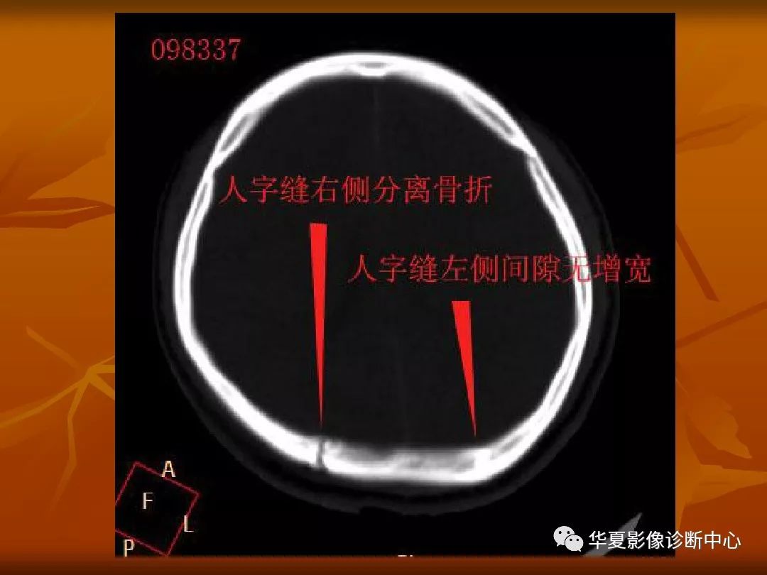 影像PPT - 【PPT】颅骨外伤性骨折CT诊断-69