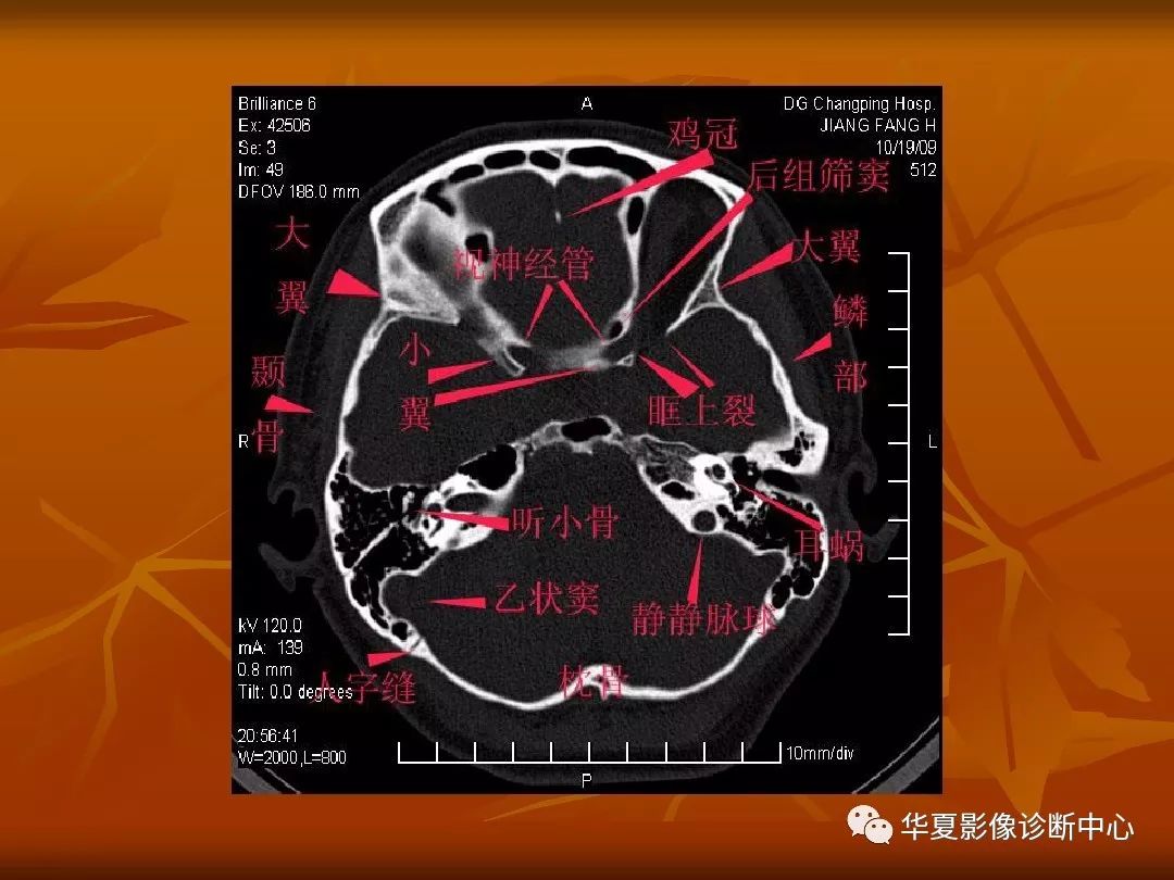 影像PPT - 【PPT】颅骨外伤性骨折CT诊断-90