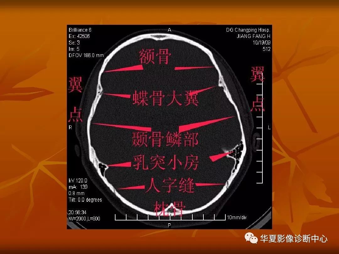 影像PPT - 【PPT】颅骨外伤性骨折CT诊断-81