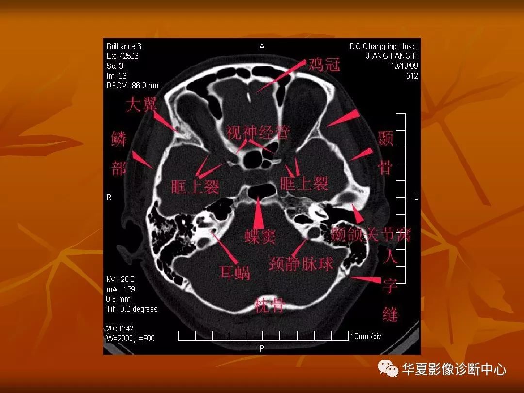 影像PPT - 【PPT】颅骨外伤性骨折CT诊断-91