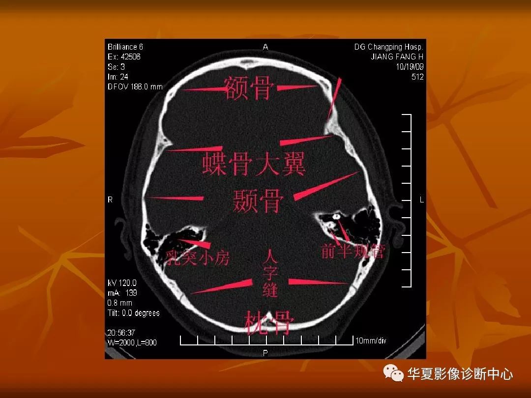 影像PPT - 【PPT】颅骨外伤性骨折CT诊断-84