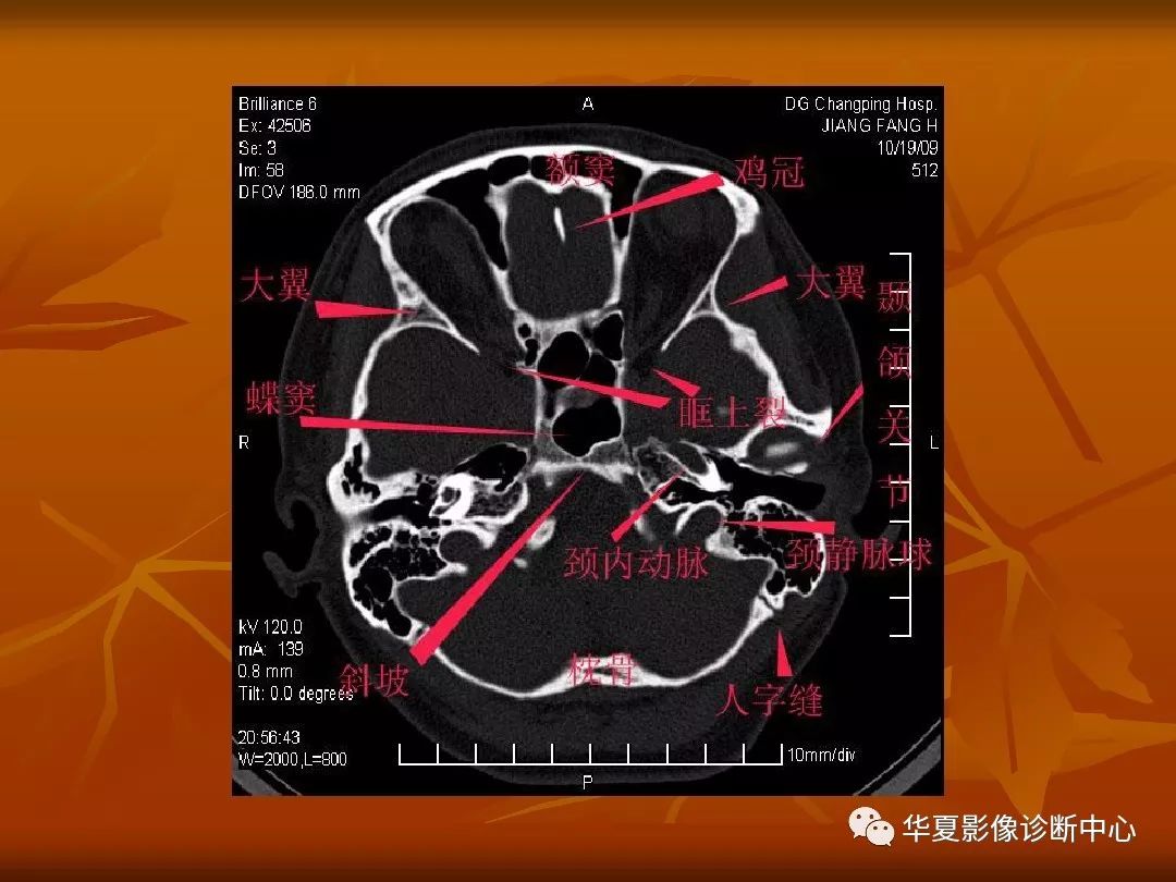 影像PPT - 【PPT】颅骨外伤性骨折CT诊断-92