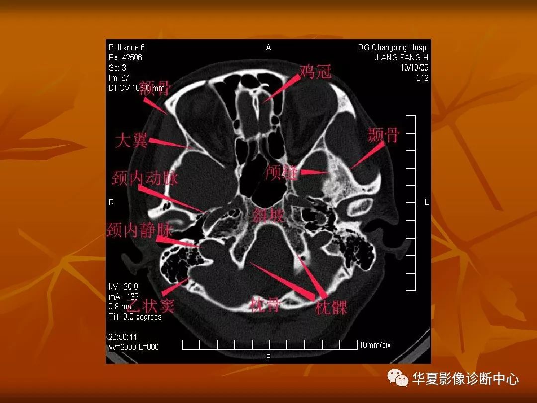 影像PPT - 【PPT】颅骨外伤性骨折CT诊断-94