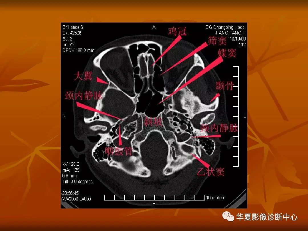 影像PPT - 【PPT】颅骨外伤性骨折CT诊断-95