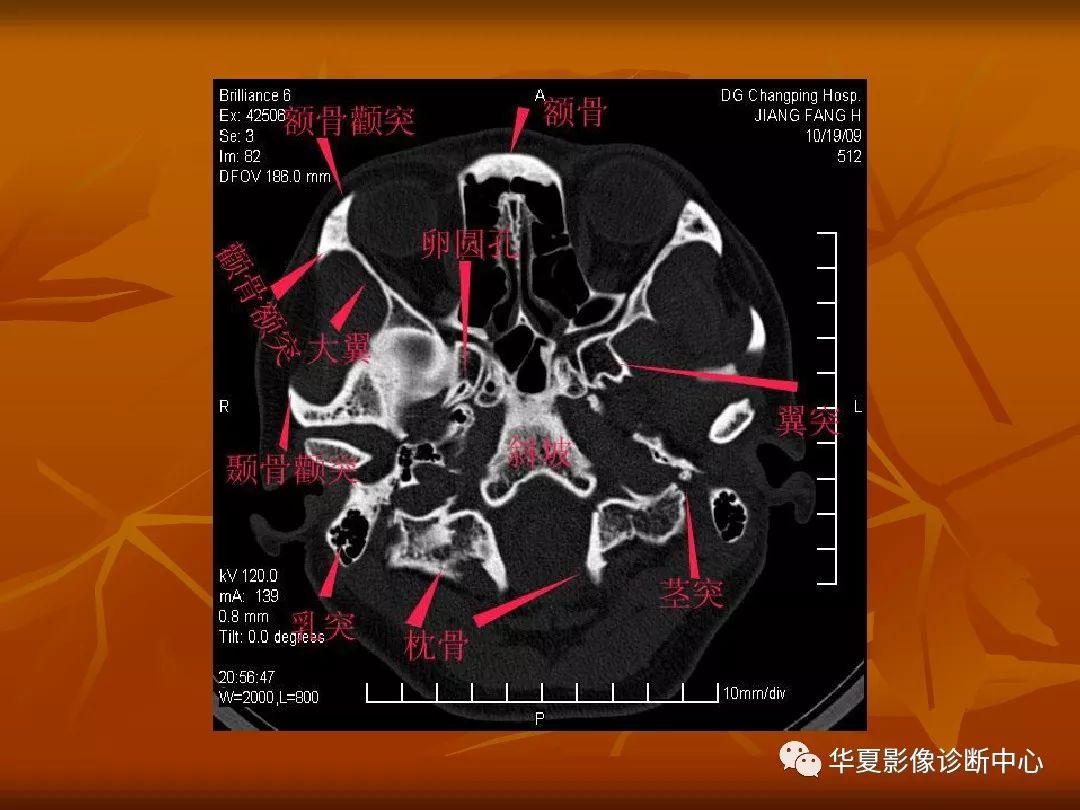 影像PPT - 【PPT】颅骨外伤性骨折CT诊断-97
