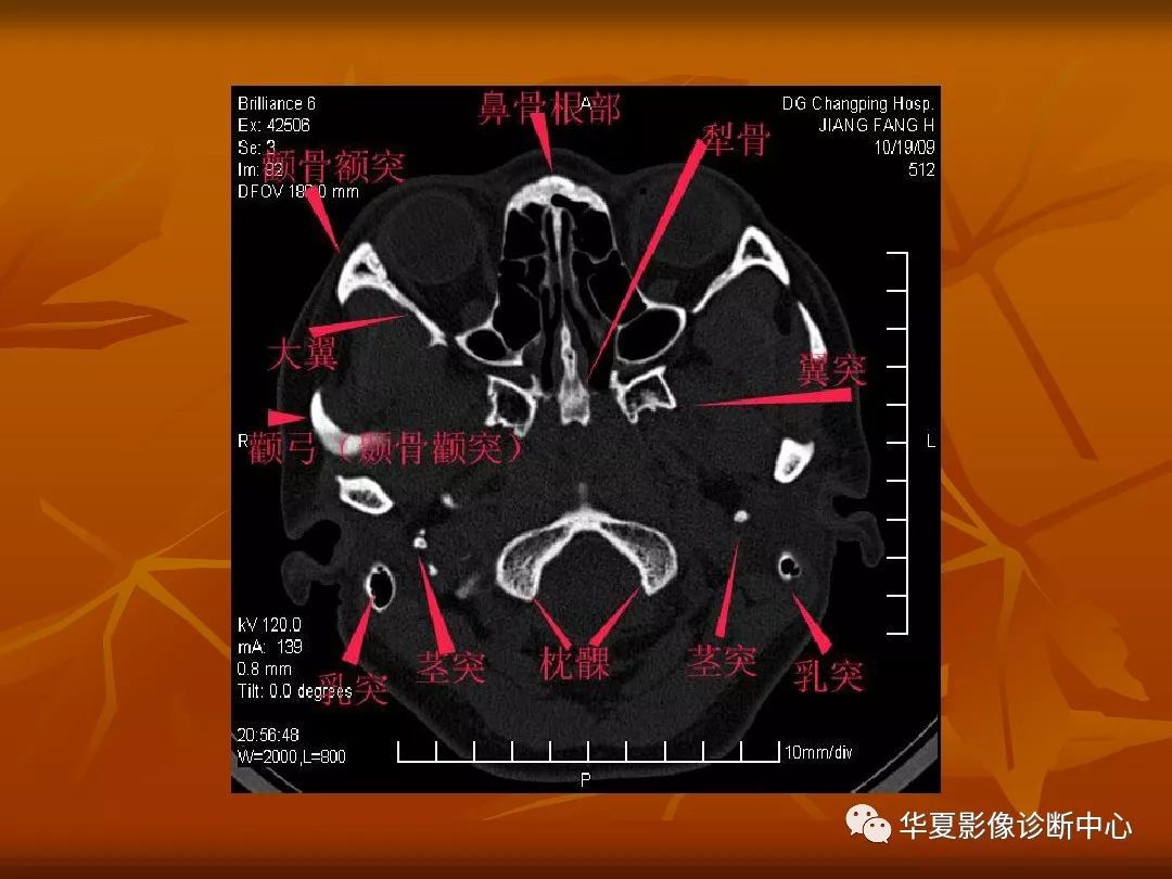 影像PPT - 【PPT】颅骨外伤性骨折CT诊断-99