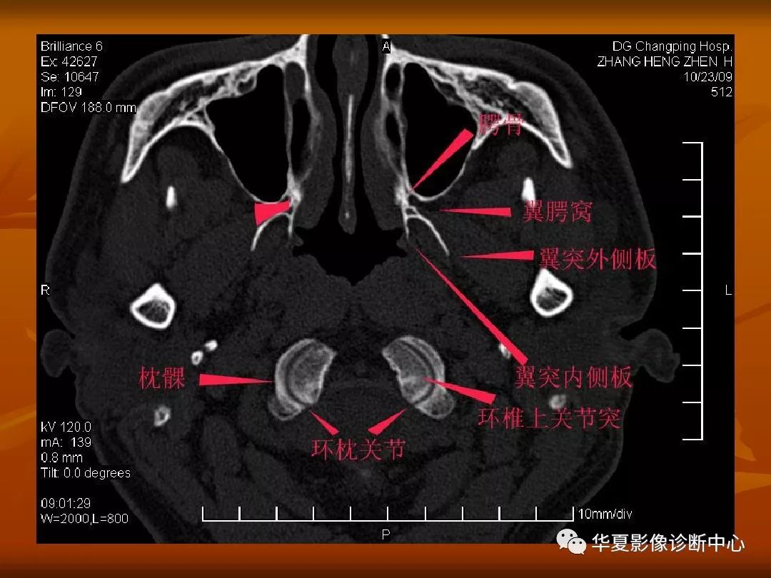 影像PPT - 【PPT】颅骨外伤性骨折CT诊断-107