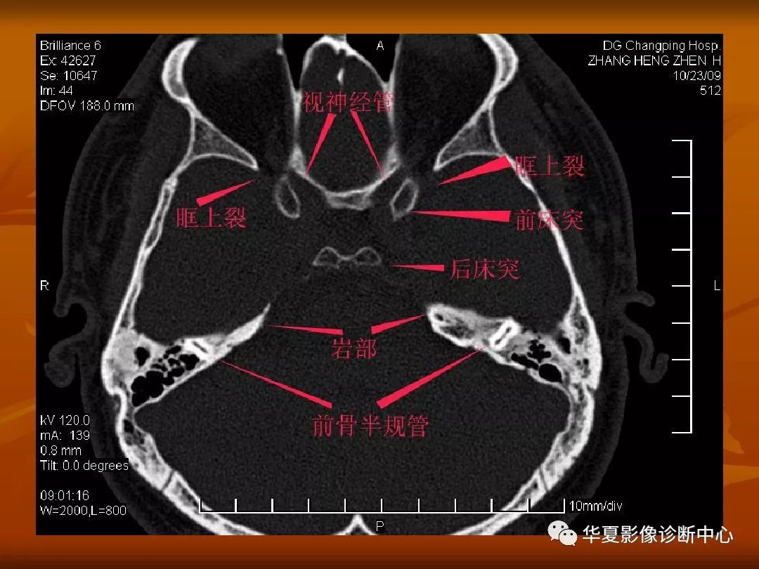 影像PPT - 【PPT】颅骨外伤性骨折CT诊断-102