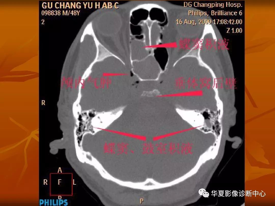 影像PPT - 【PPT】颅骨外伤性骨折CT诊断-115