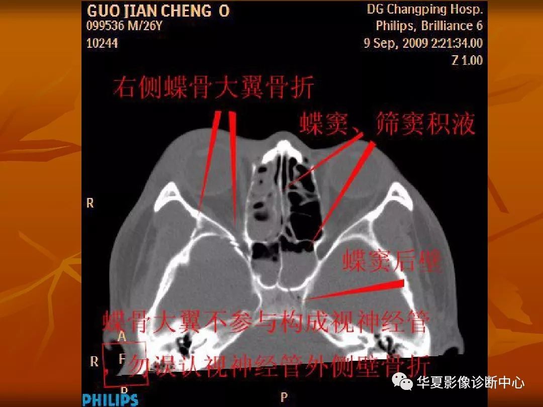 影像PPT - 【PPT】颅骨外伤性骨折CT诊断-117