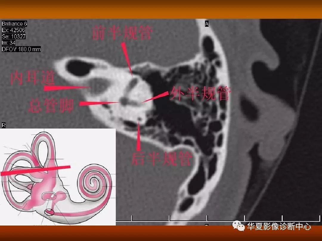 影像PPT - 【PPT】颅骨外伤性骨折CT诊断-124