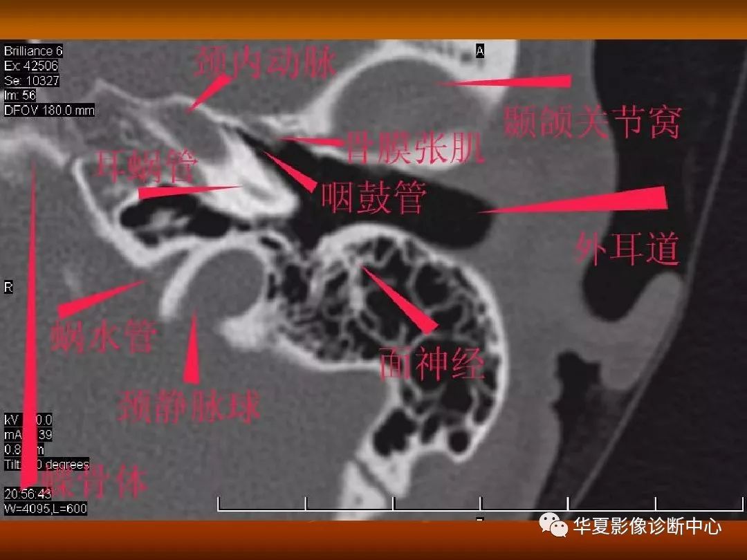影像PPT - 【PPT】颅骨外伤性骨折CT诊断-132