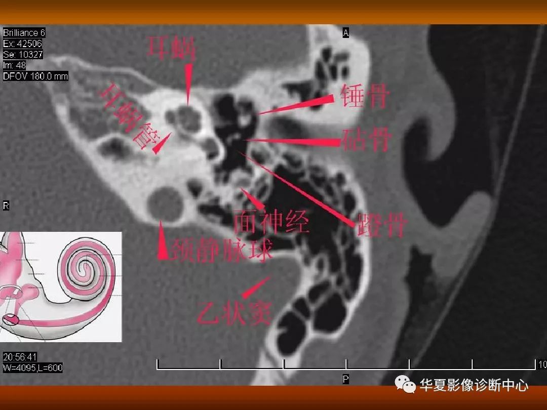 影像PPT - 【PPT】颅骨外伤性骨折CT诊断-130