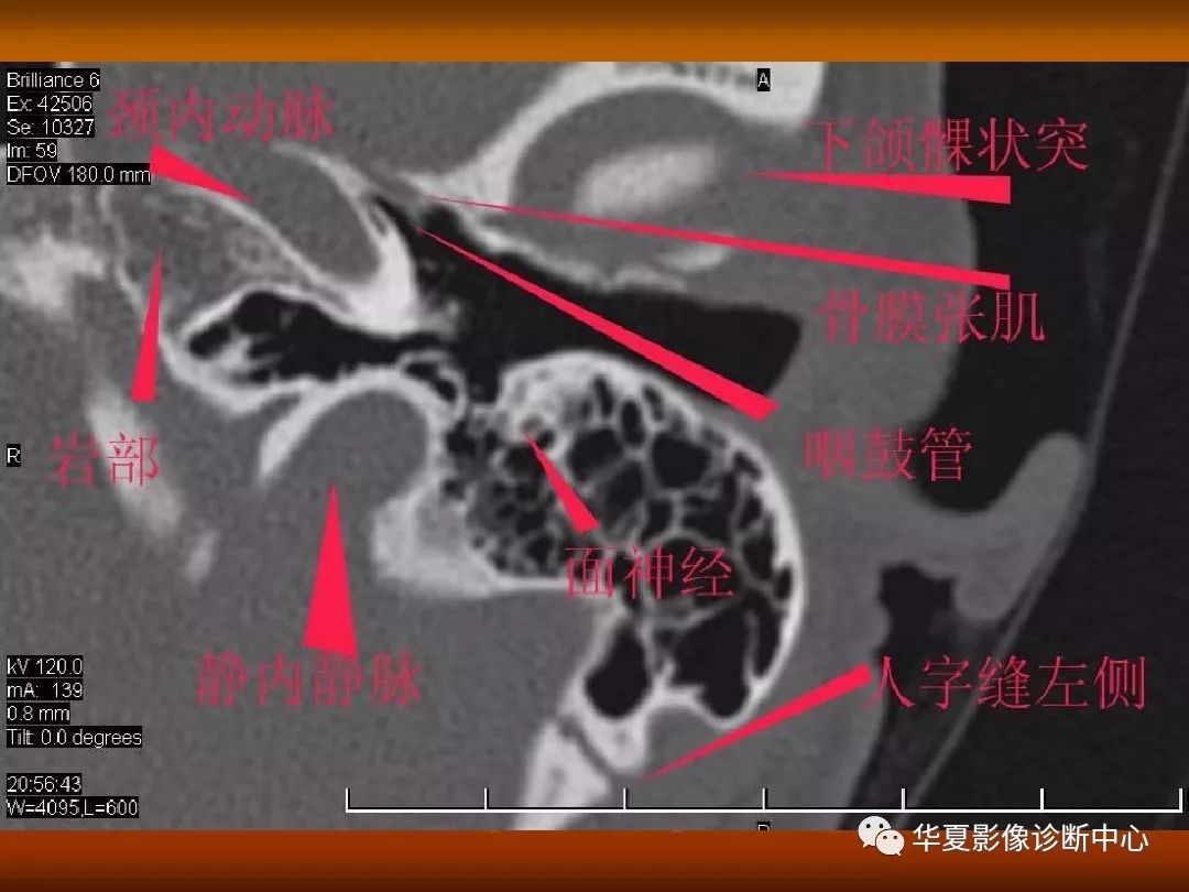 影像PPT - 【PPT】颅骨外伤性骨折CT诊断-133