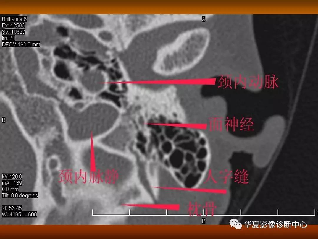 影像PPT - 【PPT】颅骨外伤性骨折CT诊断-137