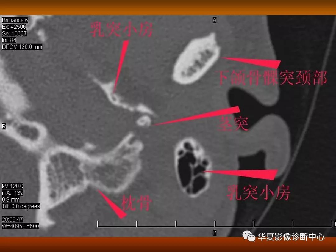 影像PPT - 【PPT】颅骨外伤性骨折CT诊断-138