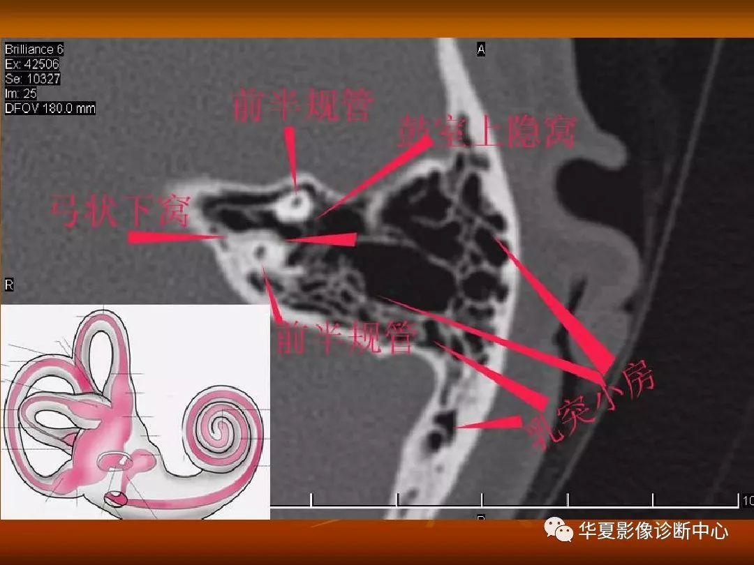 影像PPT - 【PPT】颅骨外伤性骨折CT诊断-122