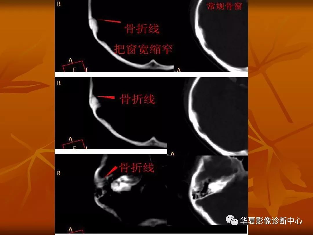 影像PPT - 【PPT】颅骨外伤性骨折CT诊断-145