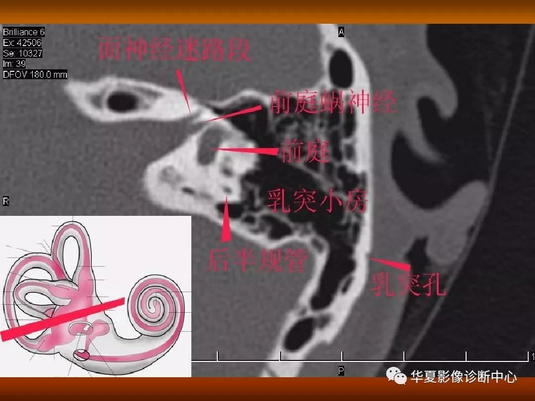影像PPT - 【PPT】颅骨外伤性骨折CT诊断-126