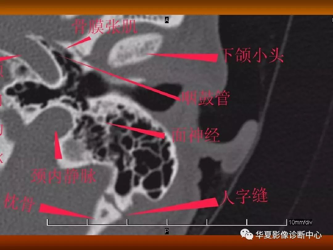 影像PPT - 【PPT】颅骨外伤性骨折CT诊断-134