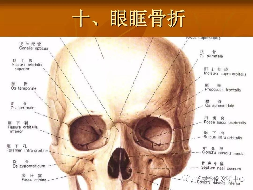影像PPT - 【PPT】颅骨外伤性骨折CT诊断-148
