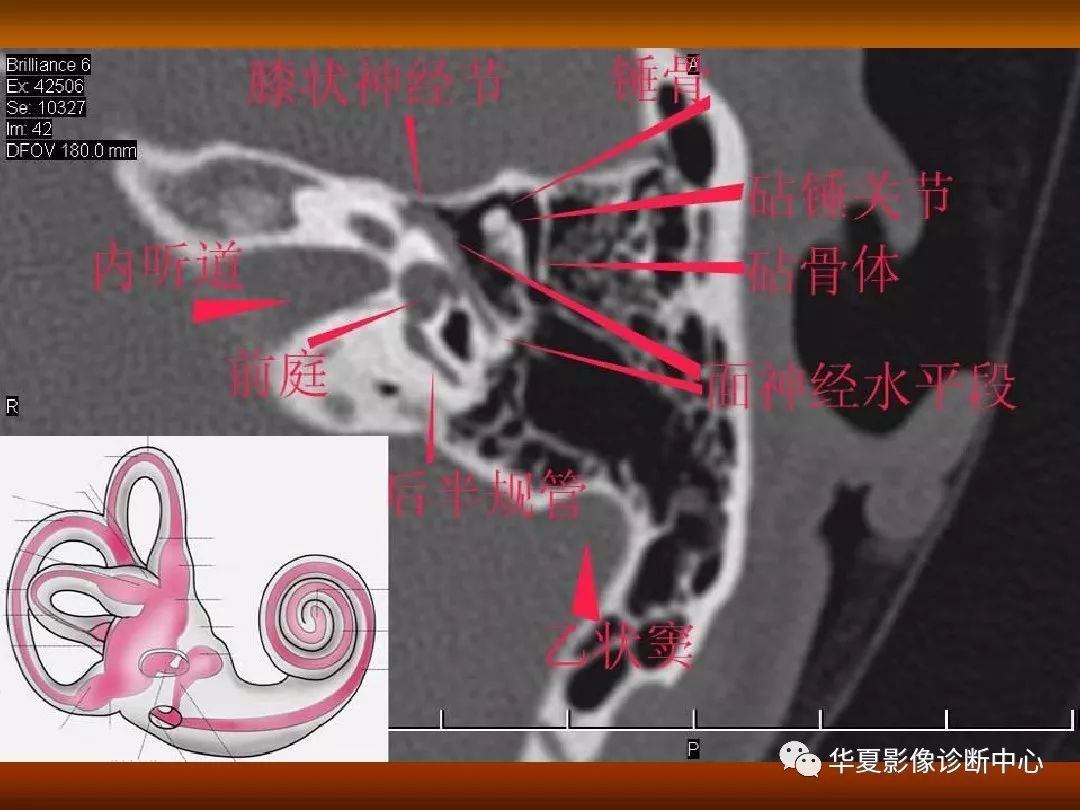 影像PPT - 【PPT】颅骨外伤性骨折CT诊断-128