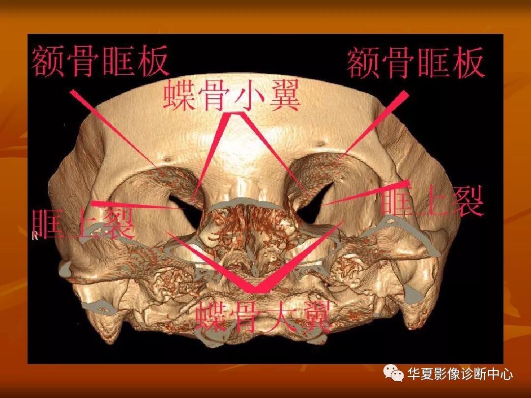 影像PPT - 【PPT】颅骨外伤性骨折CT诊断-151