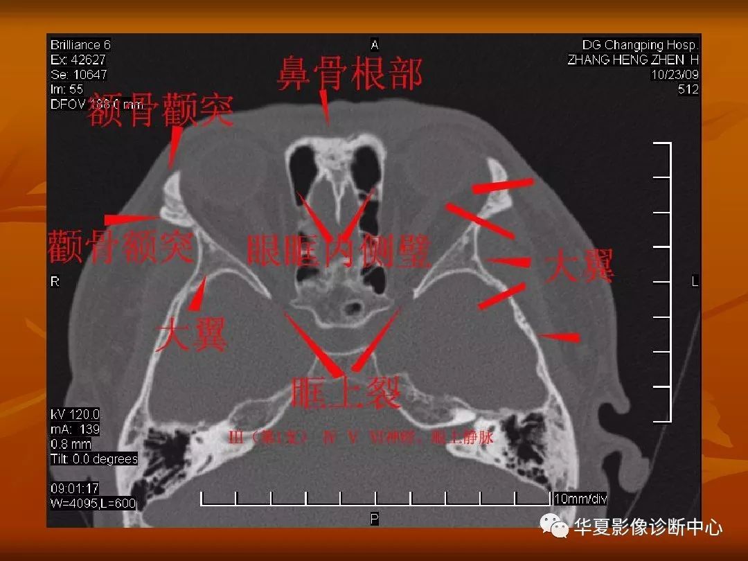影像PPT - 【PPT】颅骨外伤性骨折CT诊断-161