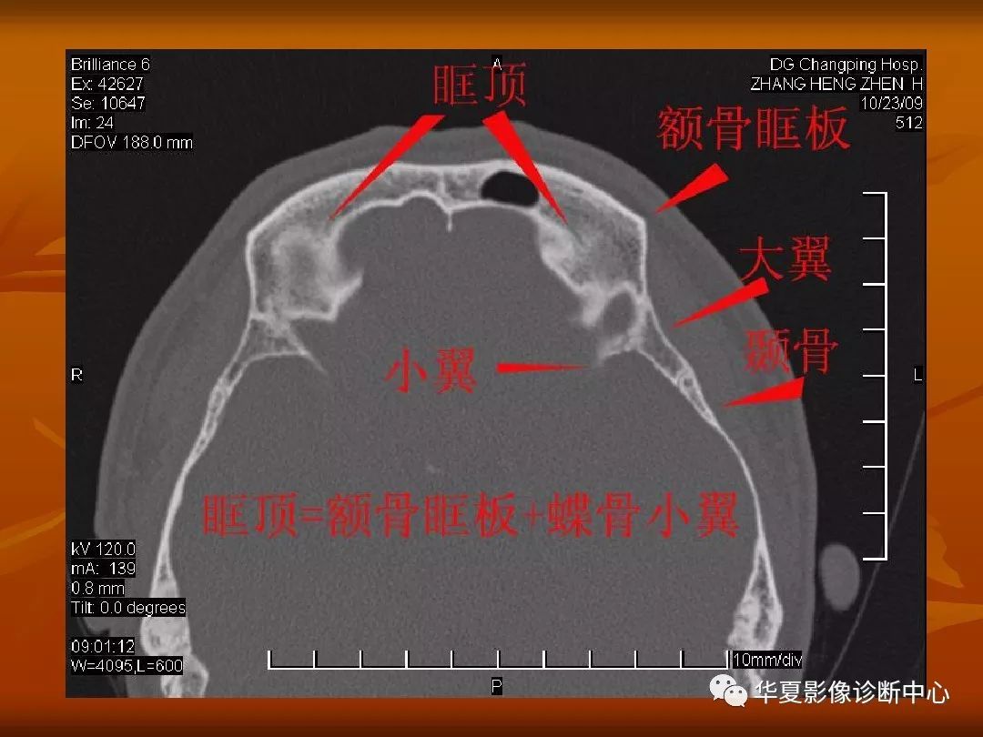 影像PPT - 【PPT】颅骨外伤性骨折CT诊断-156